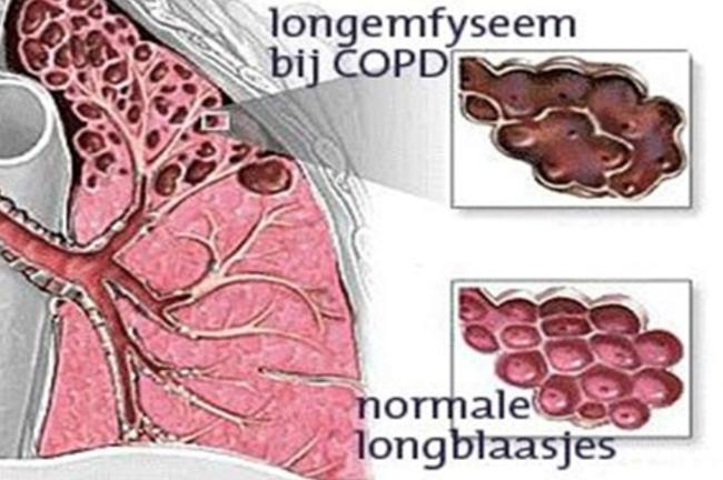 longemfyseem bij COPD